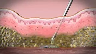 3D Medical Animation