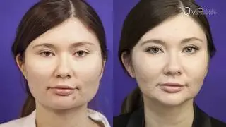 Уменьшение скул и сужение челюсти V Line. (Хирург Гурьянов А.С.)