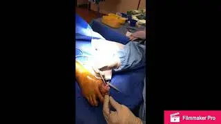 Excision of Tophaceous Gout