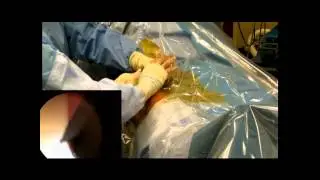 Hip Arthroscopy - Surgical video Narrated by Dr. Alan Nasar