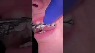 Orthodontic power chain - Tooth Time Family Dentistry New Braunfels - Dentist