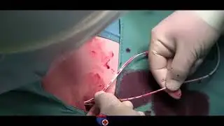 установка центрального венозного порта ( subclavia)