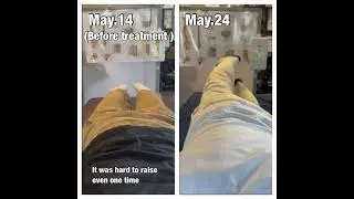 ALS result after 1 week