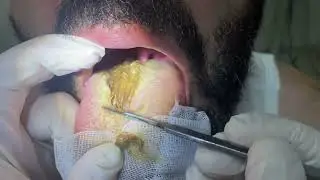 #hairytongue