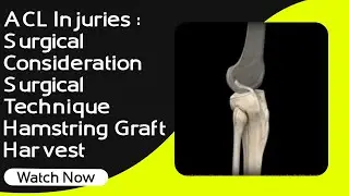 ACL Injuries : Surgical Consideration | Surgical Technique | Hamstring Graft Harvest