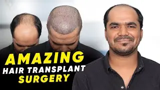 Hair Transplant in Kurukshetra | Best Results & Cost of Hair Transplant in Kurukshetra