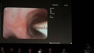2024 03 28 Первенство08 Беляев ГС Бронхотомия с криобиопсией опухоли средостения