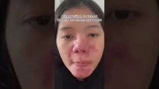 AKHIRNYA SEMBUH