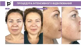 Процедура інтенсивного відбілювання