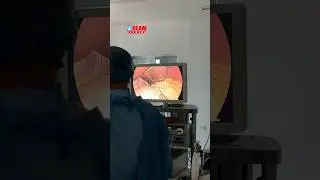 Oshqozon kichraytirish operatsiyasi… | 712725002