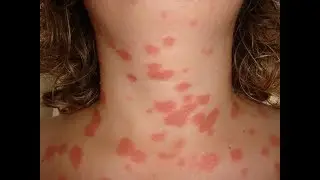 Как вылечить псориаз в домашних условиях народными средствами?