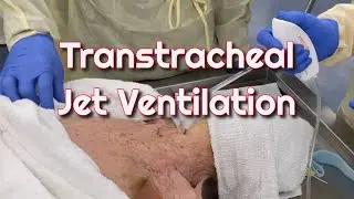 Transtracheal Jet Ventilation in a Cadaver Model