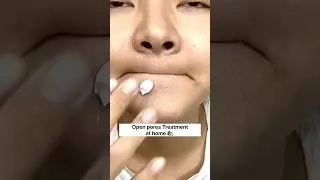 🤩Viral Open Pores Home Remedies/100%Natural Treatment At Home #blackheads#youtubeshorts#shorts#viral