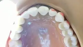 Class IV Composite on #9 - Part 2