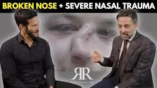 My Nose Was SHATTERED in Pieces! [BROKEN NOSE + SEVERE Nasal Trauma]