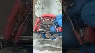 Metal Framework Try-In 