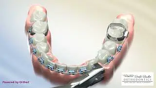 Braces Removal