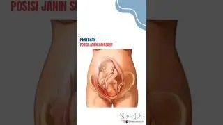Penyebab Posisi Janin Sungsang #posisijaninsungsang #edukasikehamilan