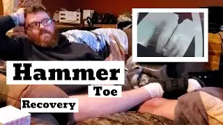 Hammer Toe Surgery // Recovery Update
