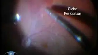 Complications of Infiltrative Anaesthesia Phaco 3.1 Complica