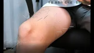 무릎이 아파서 한의원에 가면? - 무릎통증의 침치료