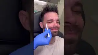 Botox for Men