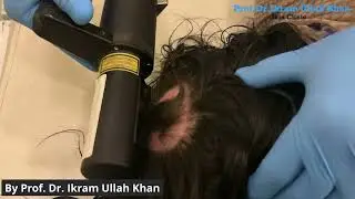 Unbelievable Hair Regrowth! Excimer 308 Laser for Alopecia Areata #alopeciaareata #lasertreatment