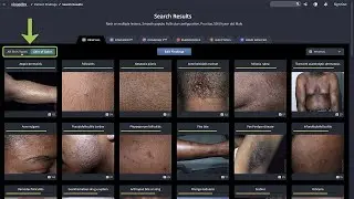 Skin of Color Feature