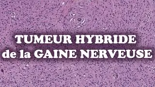 LA TUMEUR HYBRIDE DE LA GAINE NERVEUSE  – PATHOLOGIE