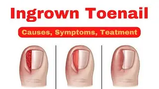 Ingrown Toenail: Causes, Symptoms and Treatment