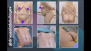 Dr. Vusal Abdullayev - Abdominoplastika