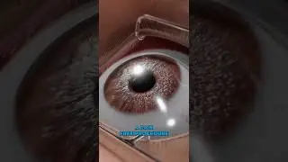 Legally blind to 20/20 in 30 minutes! (3D Animation)