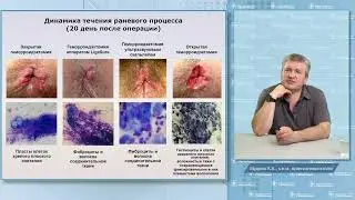 Выбор способа хирургического лечения геморроя: малоинвазивно или радикально?