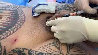 ENLARGE AND LENGTHEN YOUR PENIS WITH YOUR OWN FAT | BIGGER IS BETTER | HOLLYWOOD Dr. Jason Emer