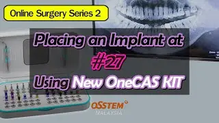 Placing Implants at #27 Using New OneCAS KIT