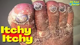 Itchy Itchy: Trimming Severe Fungal Toenails and Athlete's Foot