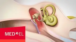 Conductive Hearing Loss Explained | MED-EL
