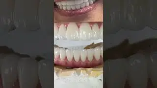 To make teeth longer!
