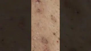 Bikini Ingrown hair removal. See Transformation!