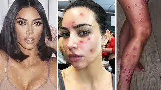 НЕ ДЛЯ СЛАБОНЕРВНЫХ: КИМ КАРДАШЬЯН ПОКАЗАЛА ПОРАЖЕННОЕ ПСОРИАЗОМ ЛИЦО