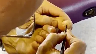 Deep foot and toe massage using massage tools. Brandon massaging Richard’s big toe part 2