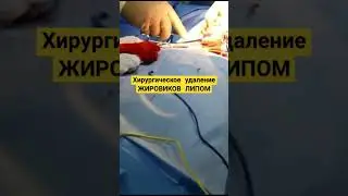 Хирургическое удаление Жировика #здоровье #здоровьеидолголетие #медицина #заздоровье #лайфхаки