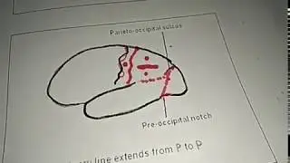 Cerebrum  sulci gyri of occipital lobe (cadaver use in this video)