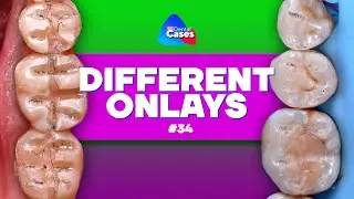 Different onlays | BG Dental Cases #34