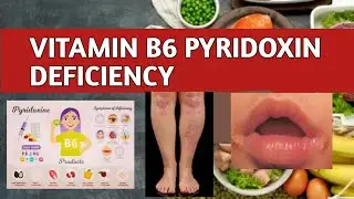Vitamin B6 Pyridoxin Deficiency Food Sources, Causes, Symptoms, Diagnosis, & Treatment