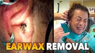 MASSIVE EARWAX REMOVAL! | Dr. Paul