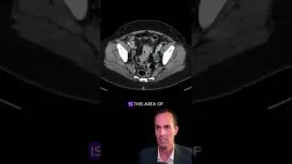 Liver metastases from colorectal cancer 