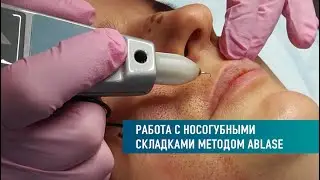 Работа с носогубными складками методом Ablase