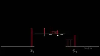 Mitral Valve Prolapse Heart Sound 
