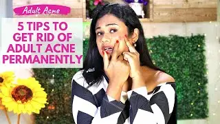Top 5 Reasons That Cause Adult Acne - How To Remove Pimples & Acne Overnight | Sushmita's Diaries